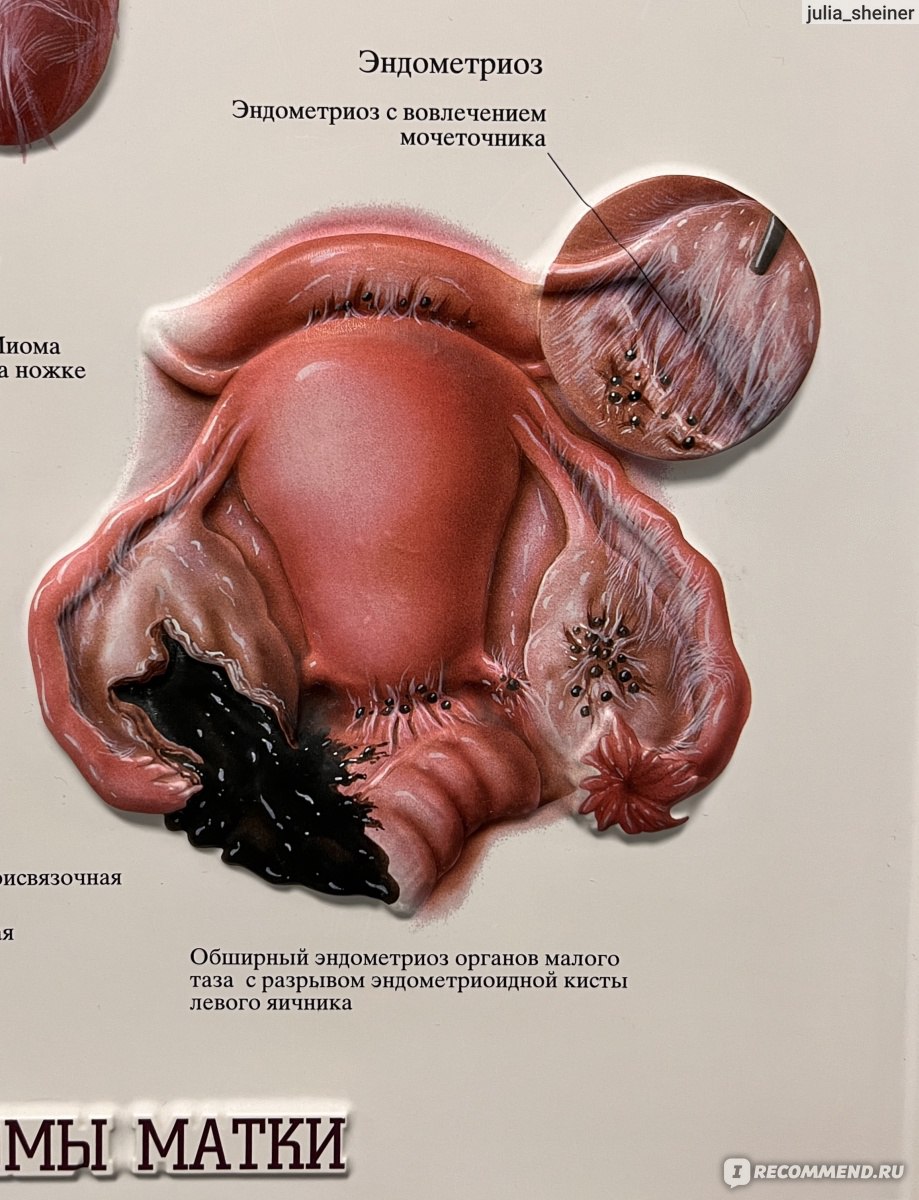 Хирургическое удаление эндометриоза - ««Юля, ты уже долго спишь,  просыпайся. Нужно проснуться. Открой глаза!» Как я в прошлом году перенесла  две лапароскопии из-за эндометриоза, зная о последствиях такого решения для  организма» |
