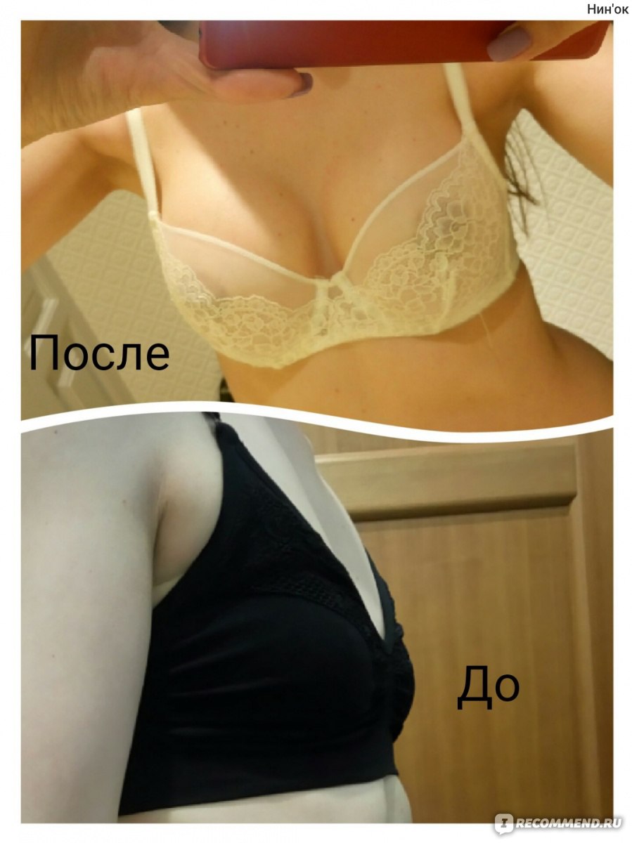Маммопластика фото до и после 2 размер