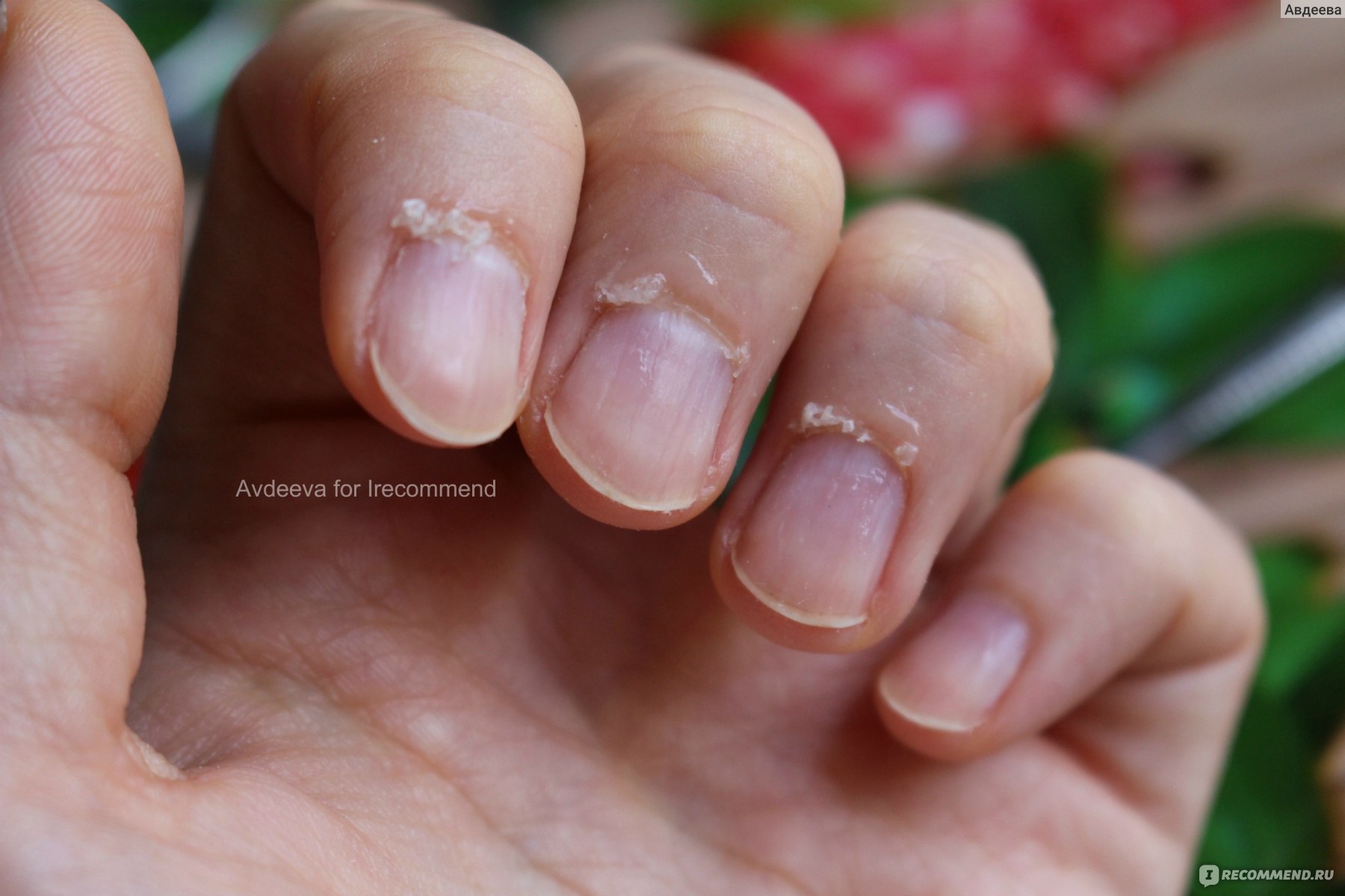 Птеригий на ногтях — методы удаления