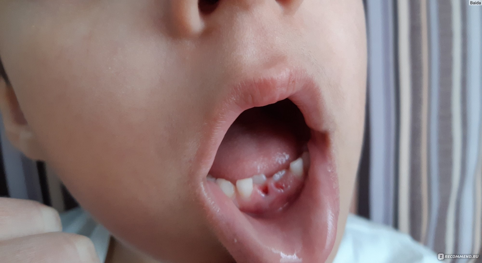 Выпадение молочных зубов у детей - возраст, сроки, схема, порядок