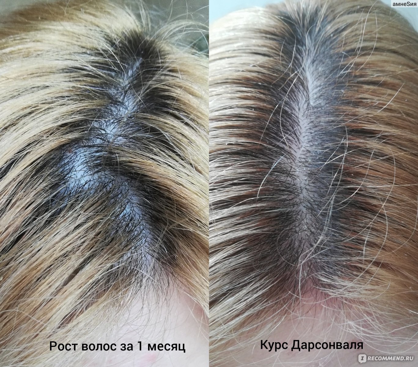 Дарсонваль для волос помогает ли отрастить волосы
