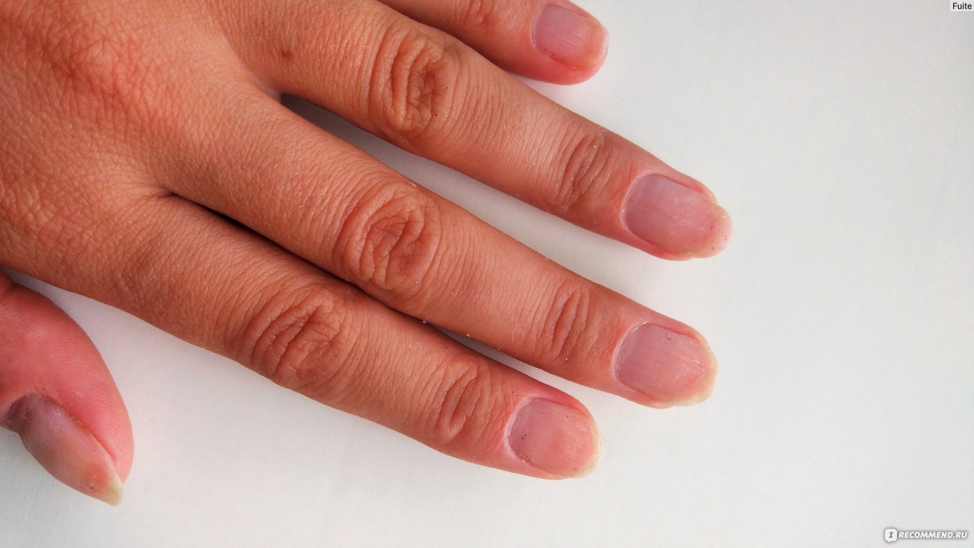 Ногти без праймера. Аллергия на праймер для ногтей. Аллергия на кислотный праймер. Ногти после кислотного праймера.