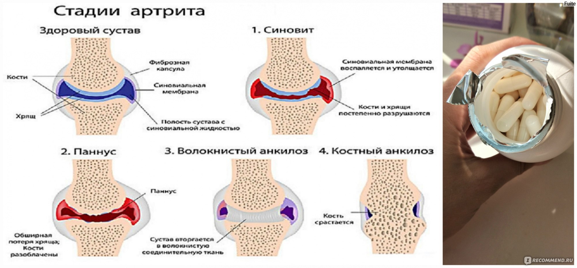 Степени артрита коленного сустава ревматоидный