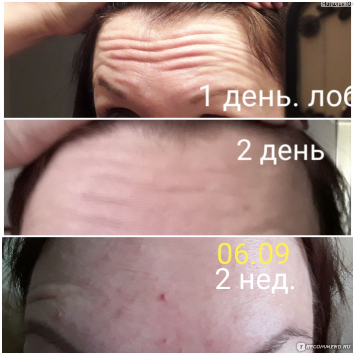 Инъекции препарата Ботулакс - «Теперь думаю о последствиях» | отзывы