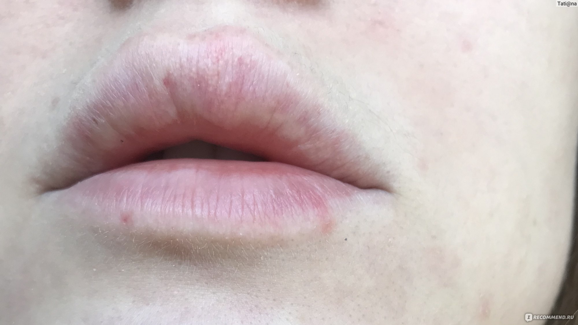 Появление гранул Фордайса на губах после введения филлеров