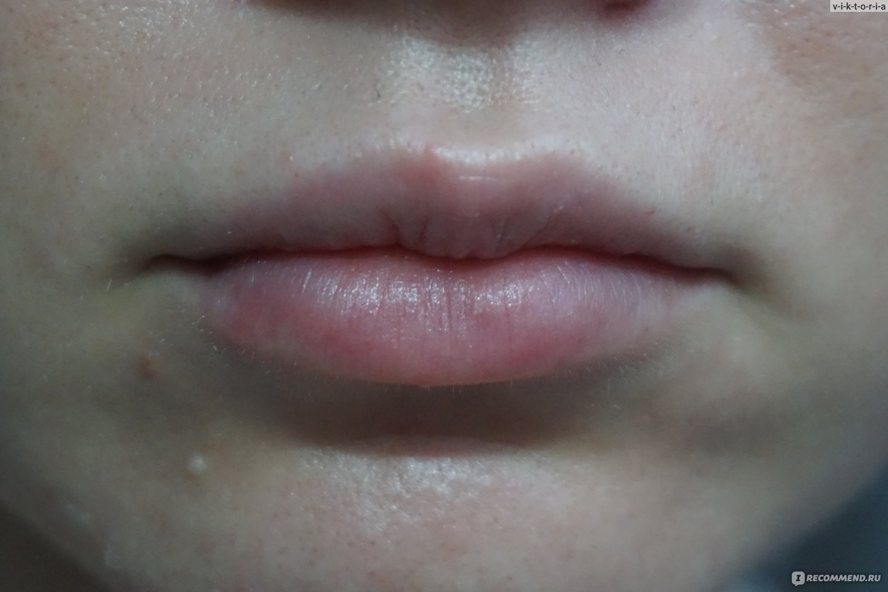 Синяки на губах после гиалуроновой кислоты