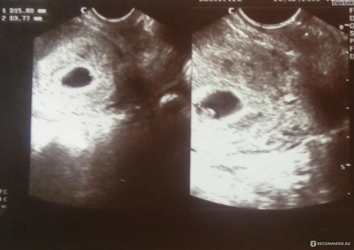 Фото узи двойни на 5 неделе беременности