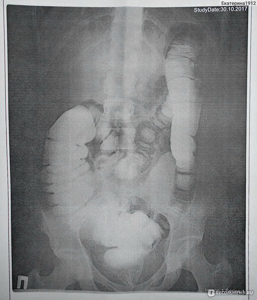 Ирригография кишечника. Долихосигма ирригоскопия. Кишечная непроходимость ирригоскопия. Ирригоскопия кишечника долихосигма. Долихосигма кишечника рентген.