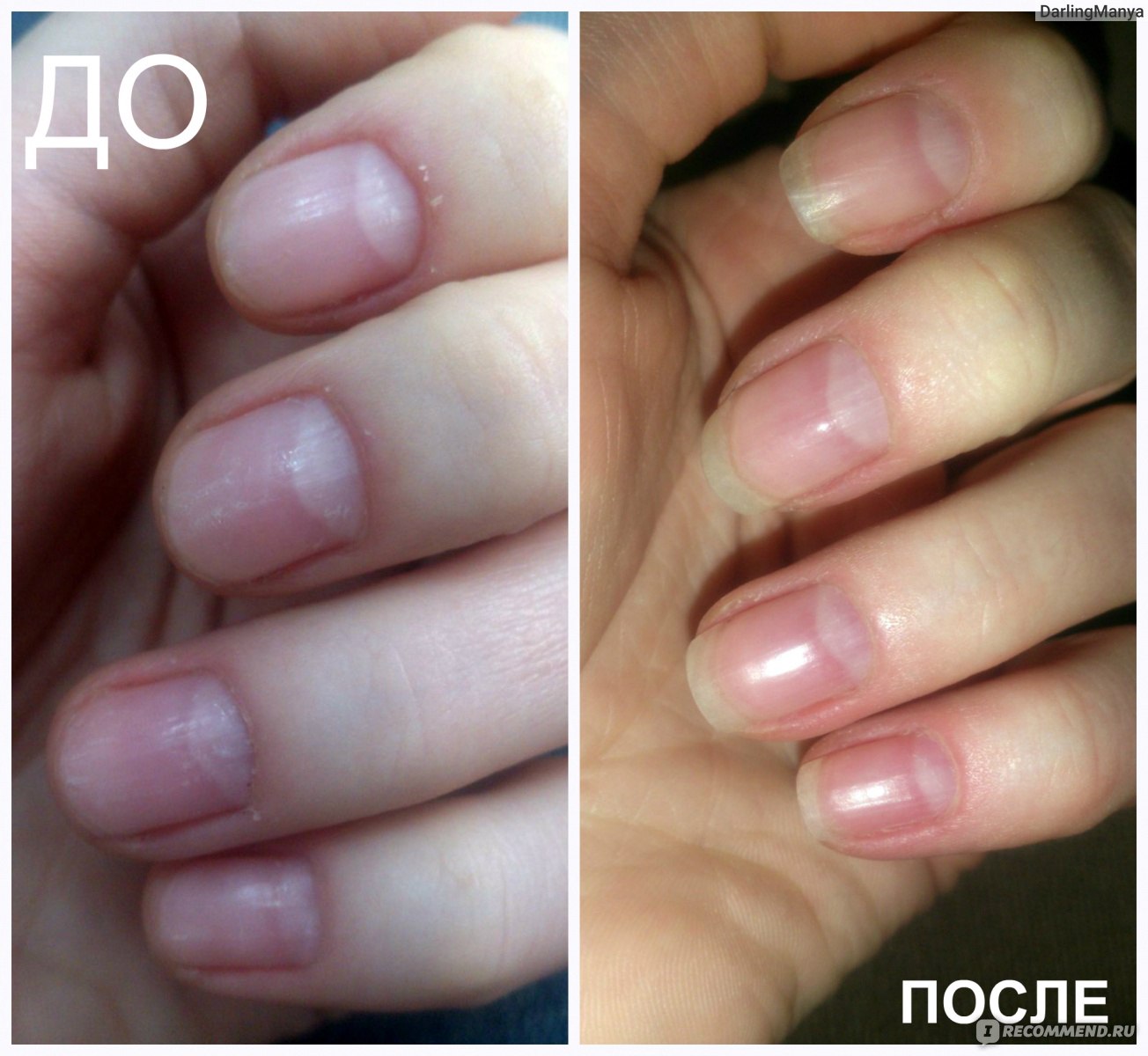 Маникюр отросшие ногти до и после