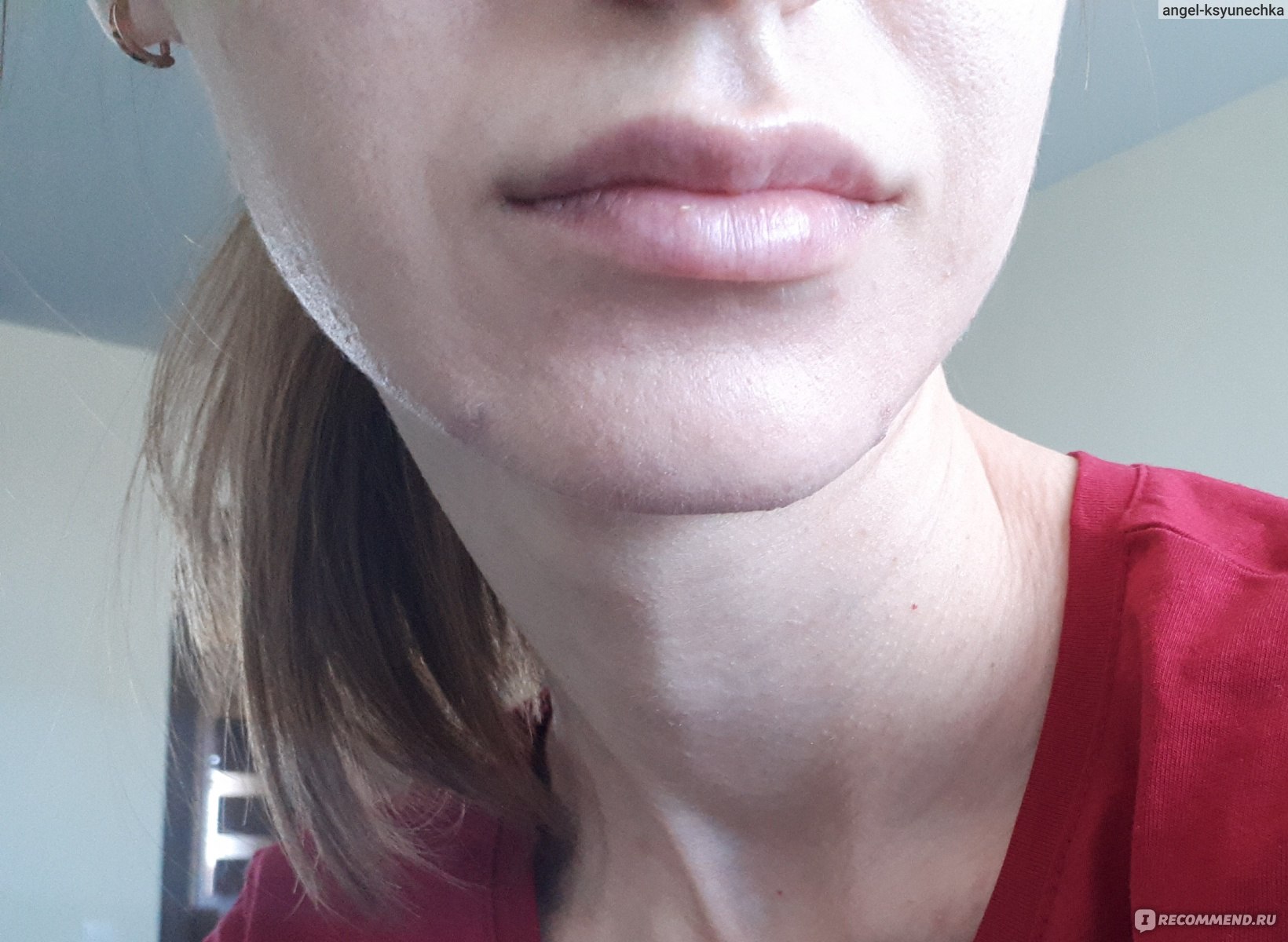 Синяки от увеличения губ