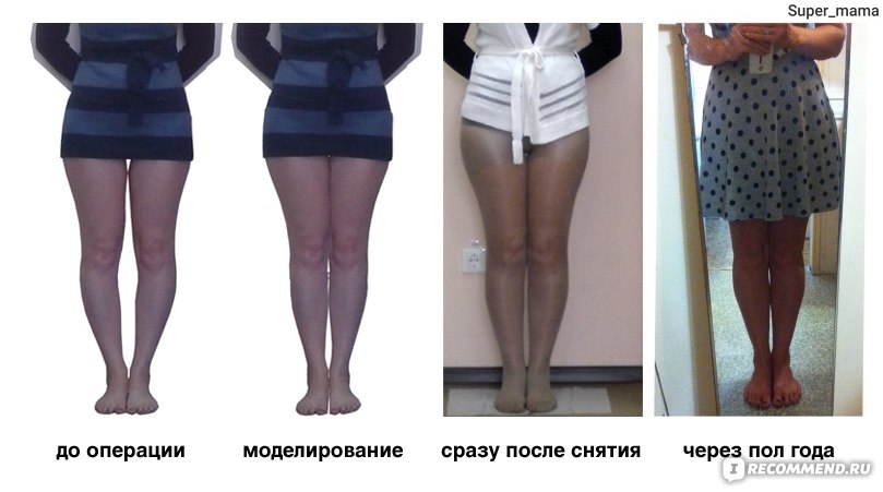 Correction of leg shape: non-surgical and surgical methods