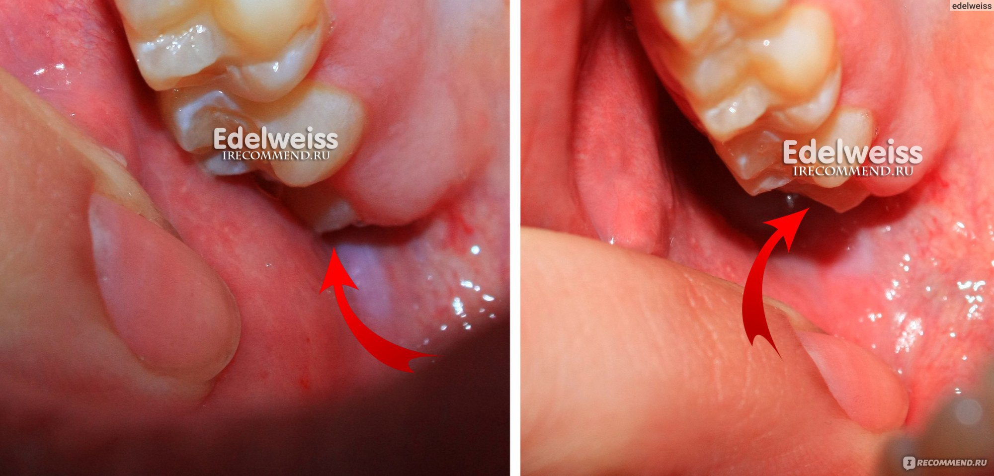 Удаление непрорезавшихся зубов | Элегра