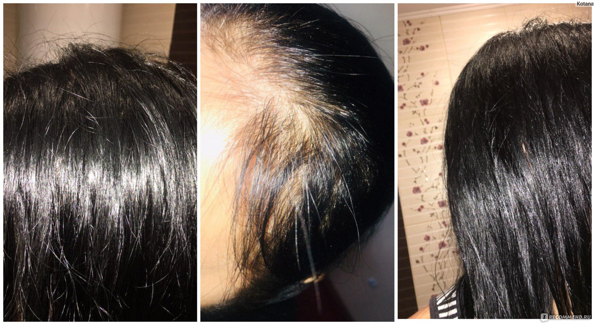 Как принимать льняное масло при выпадении волос