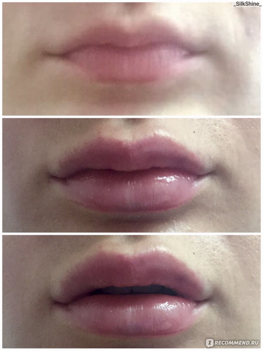 Увеличение губ на 1 мл фото до и после заживления