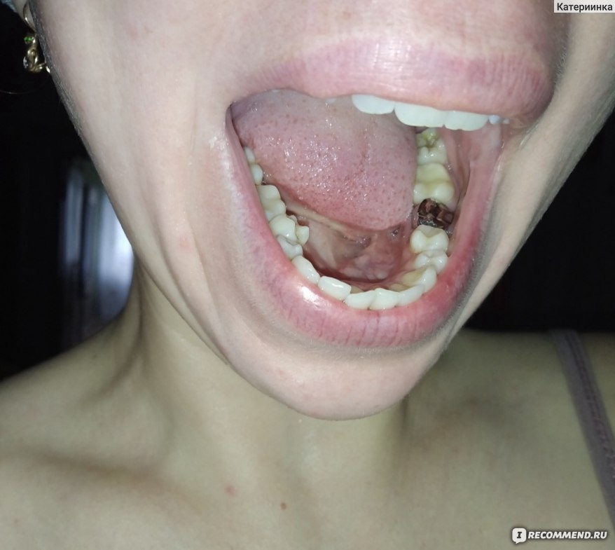 Протезирование зубов. Цельнометаллические коронки
