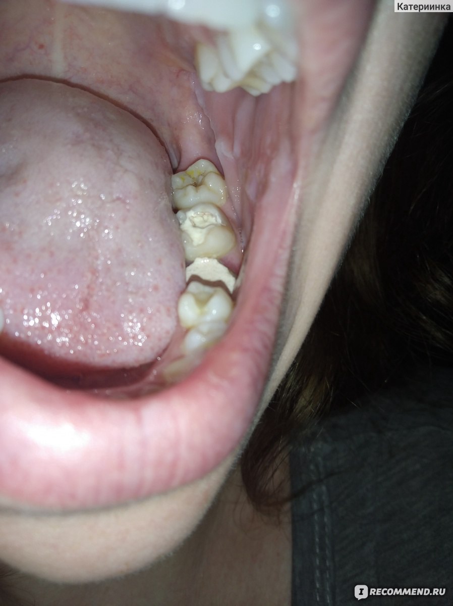 Протезирование зубов. Цельнометаллические коронки