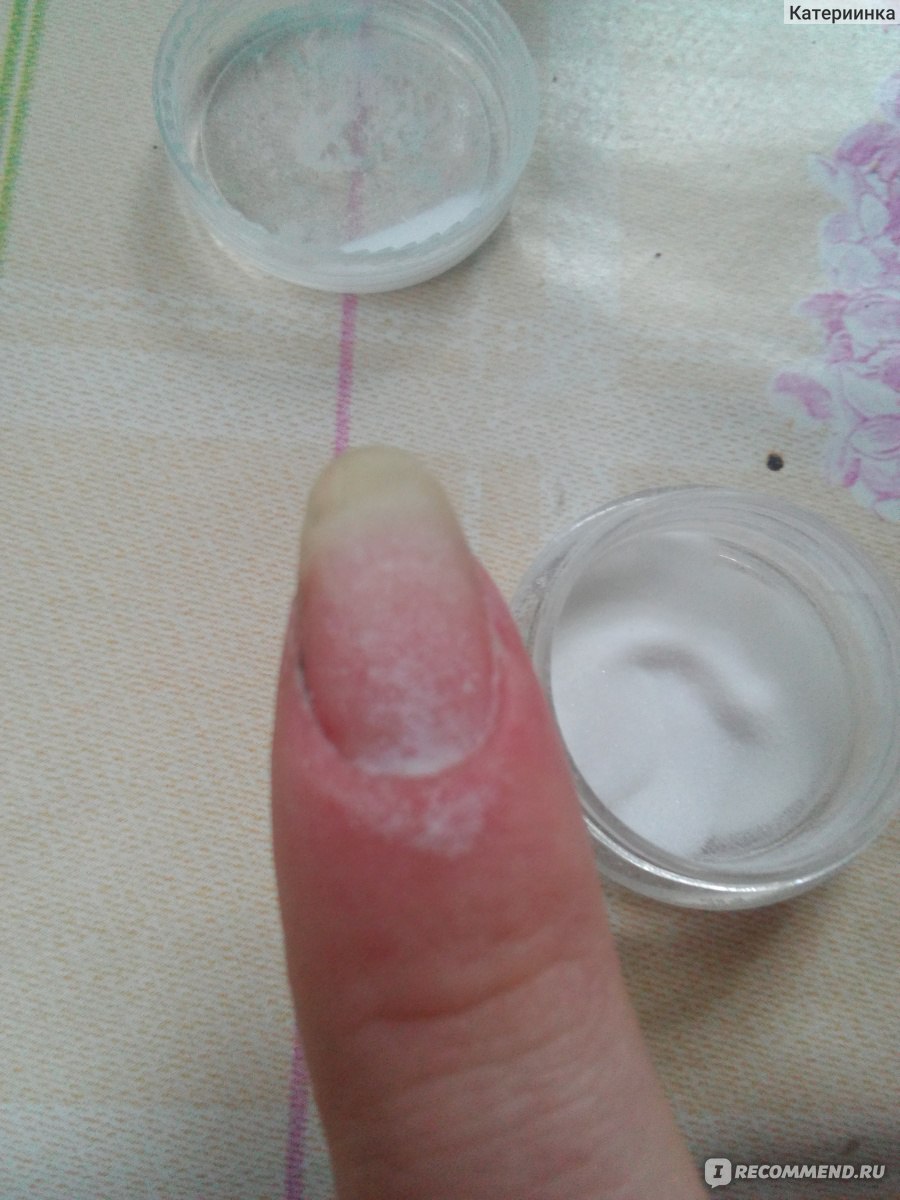 Аллергия на акриловую пудру для ногтей