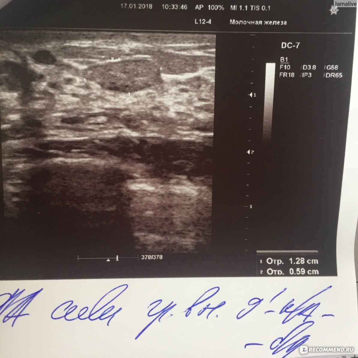 беременность фиброаденома груди фото 80