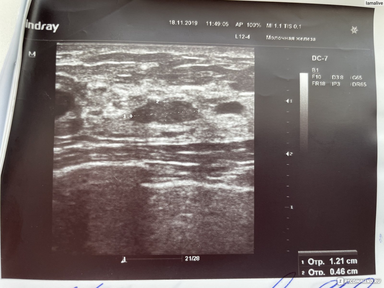 фиброаденома в груди во время беременности фото 83