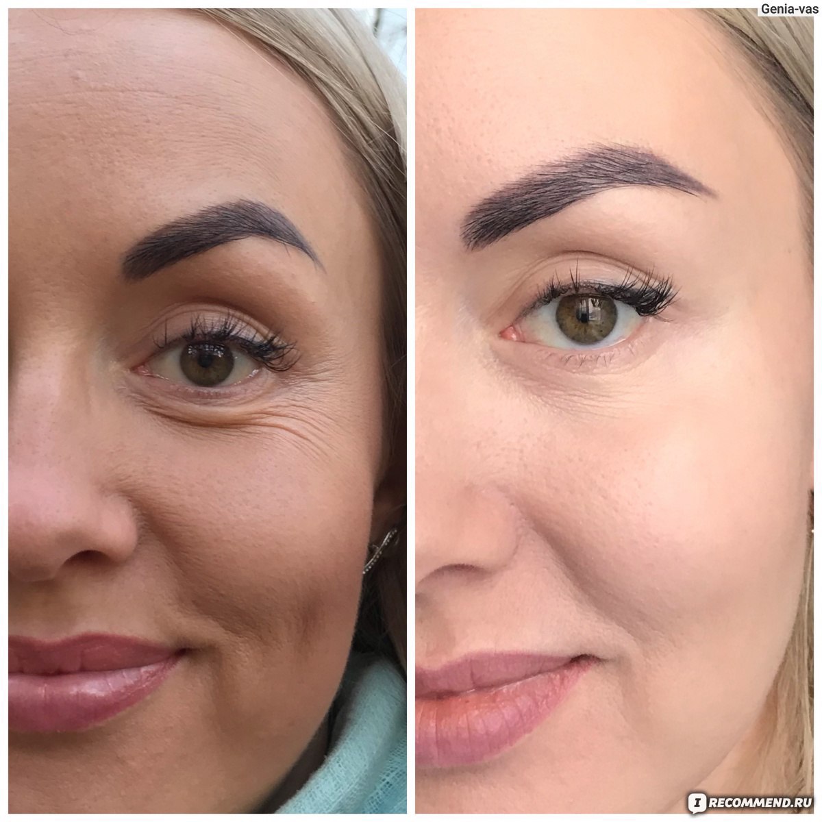 Неинвазивный тест НИПТ  фото