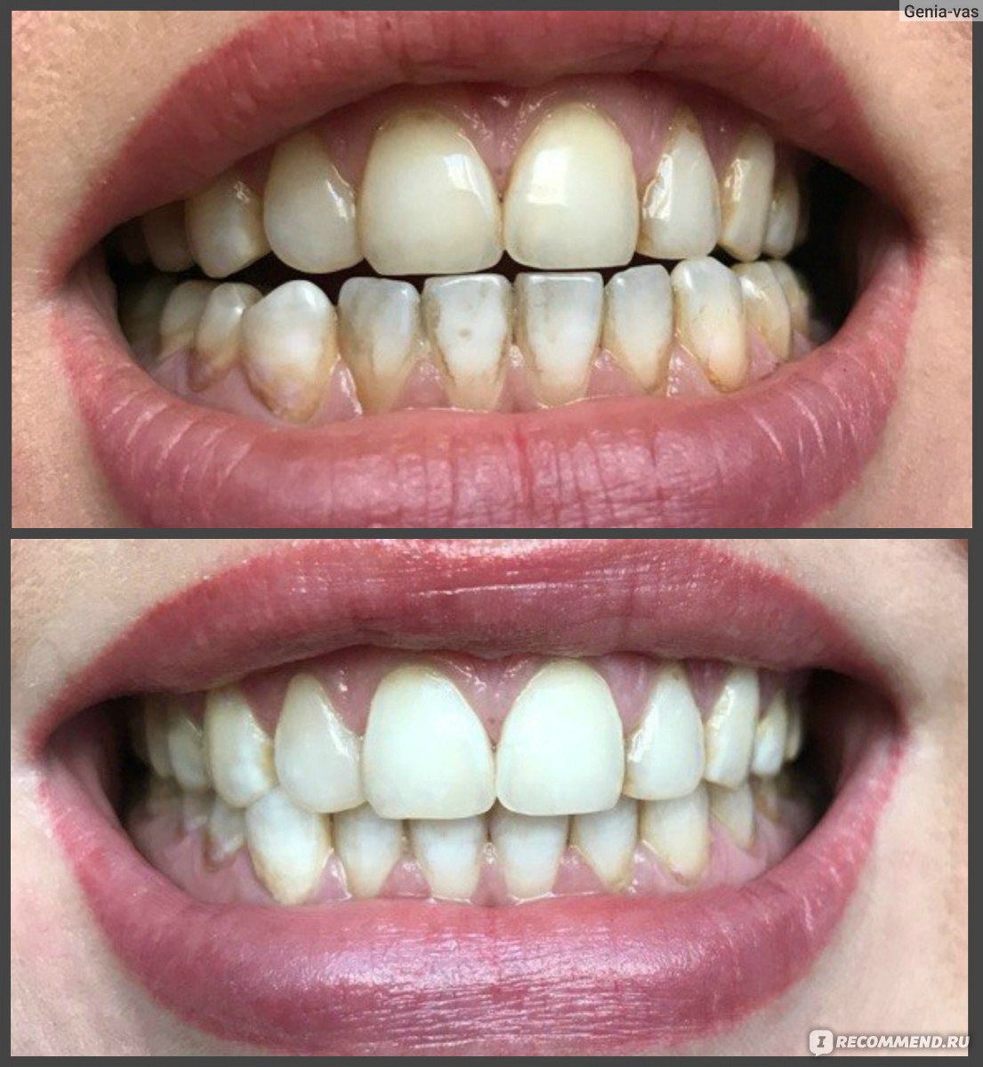 Отбеливание зубов с белыми пятнами на зубах замена электрической зубной щетки oral