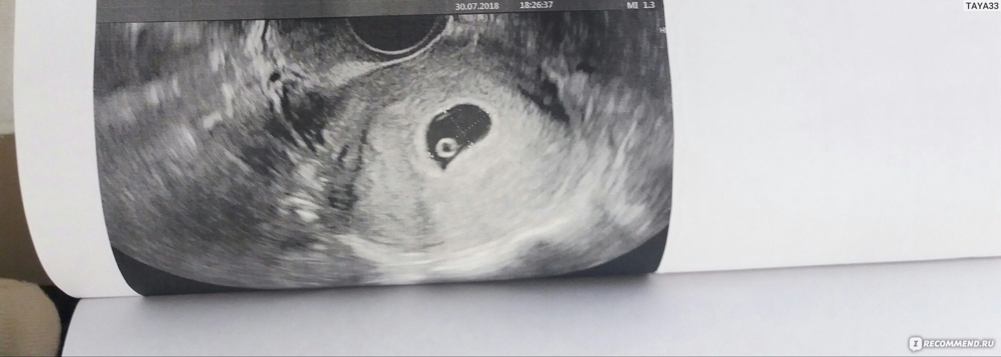 Осмотр на кресле в 37 недель беременности