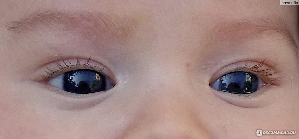 Особенности глаз недоношенных детей