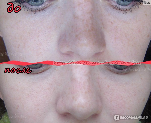 Осветление кожи перекисью водорода фото до и после
