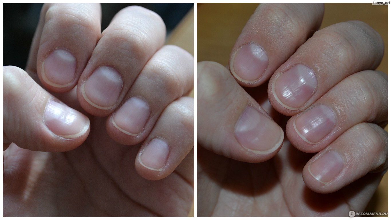 Маникюр на короткие обгрызанные ногти фото до и после