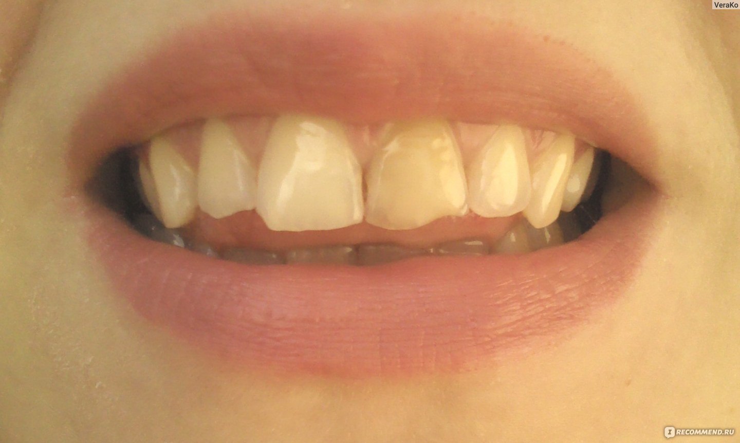 Зубы с желтоватым оттенком