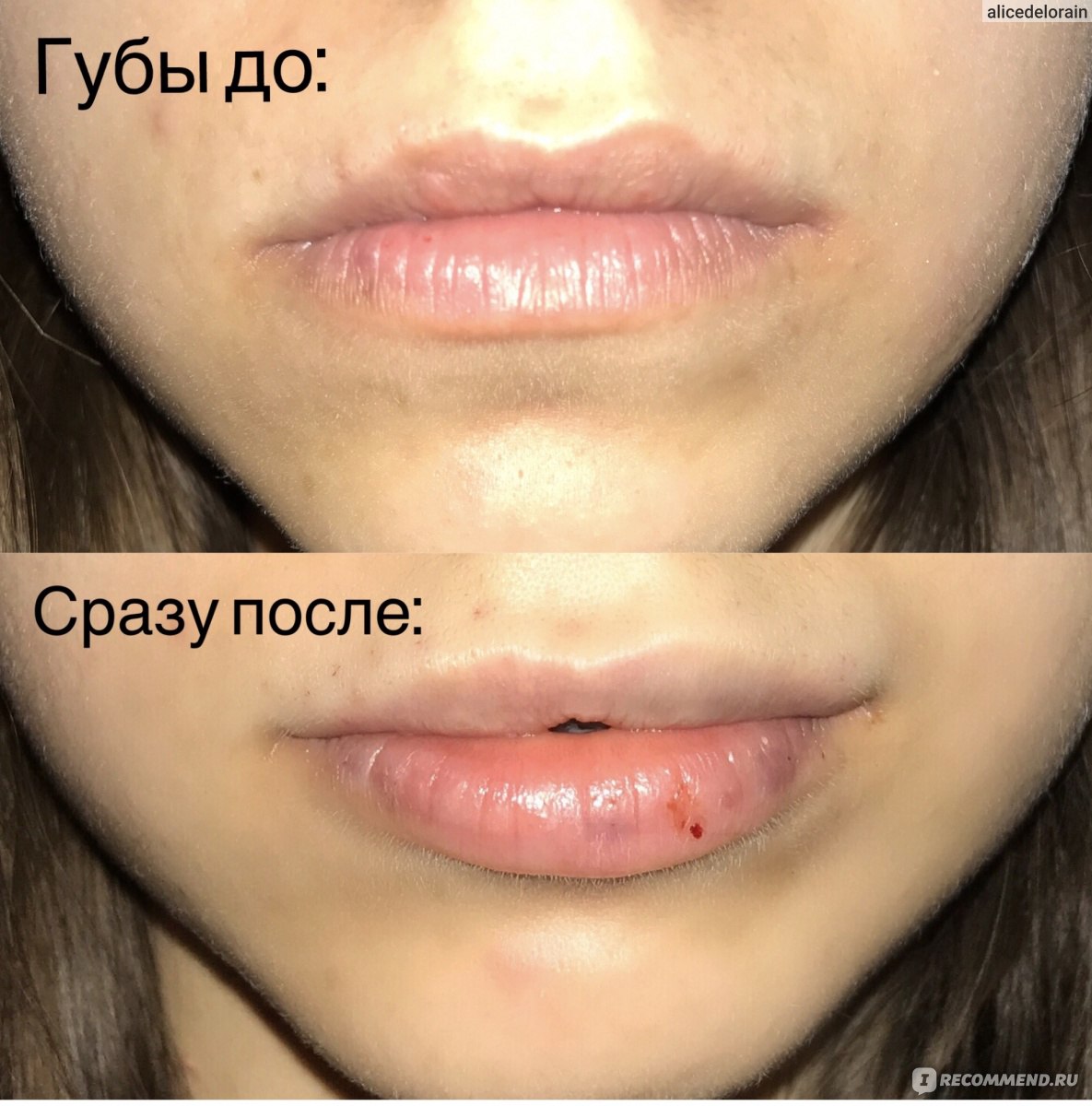 1 день после губ