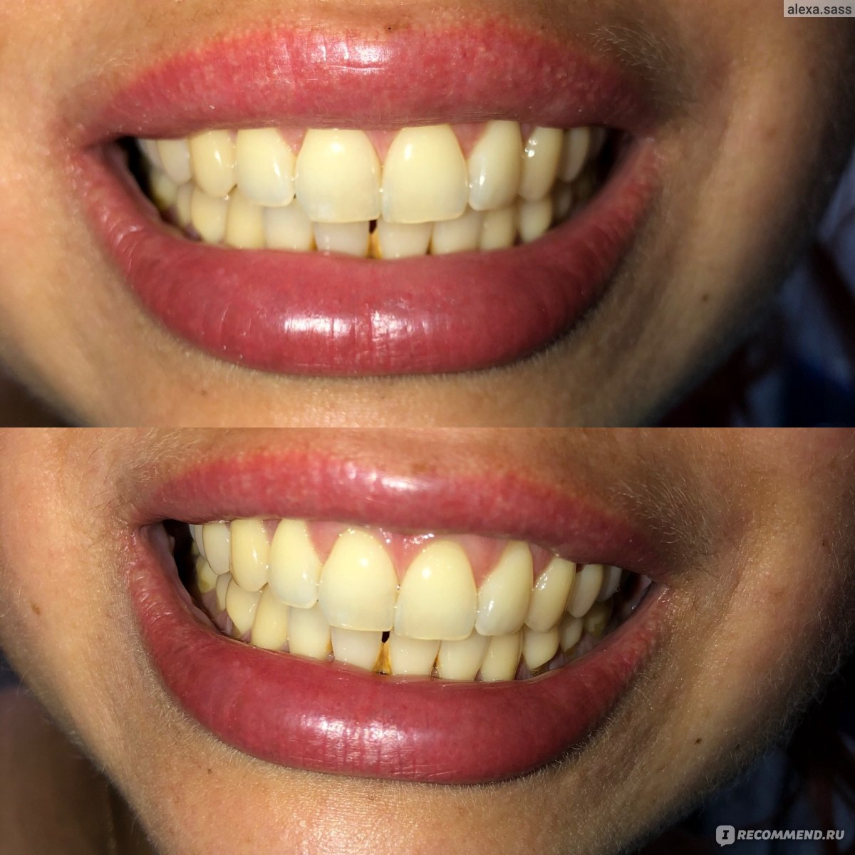 Отбеливание реставрированных зубов