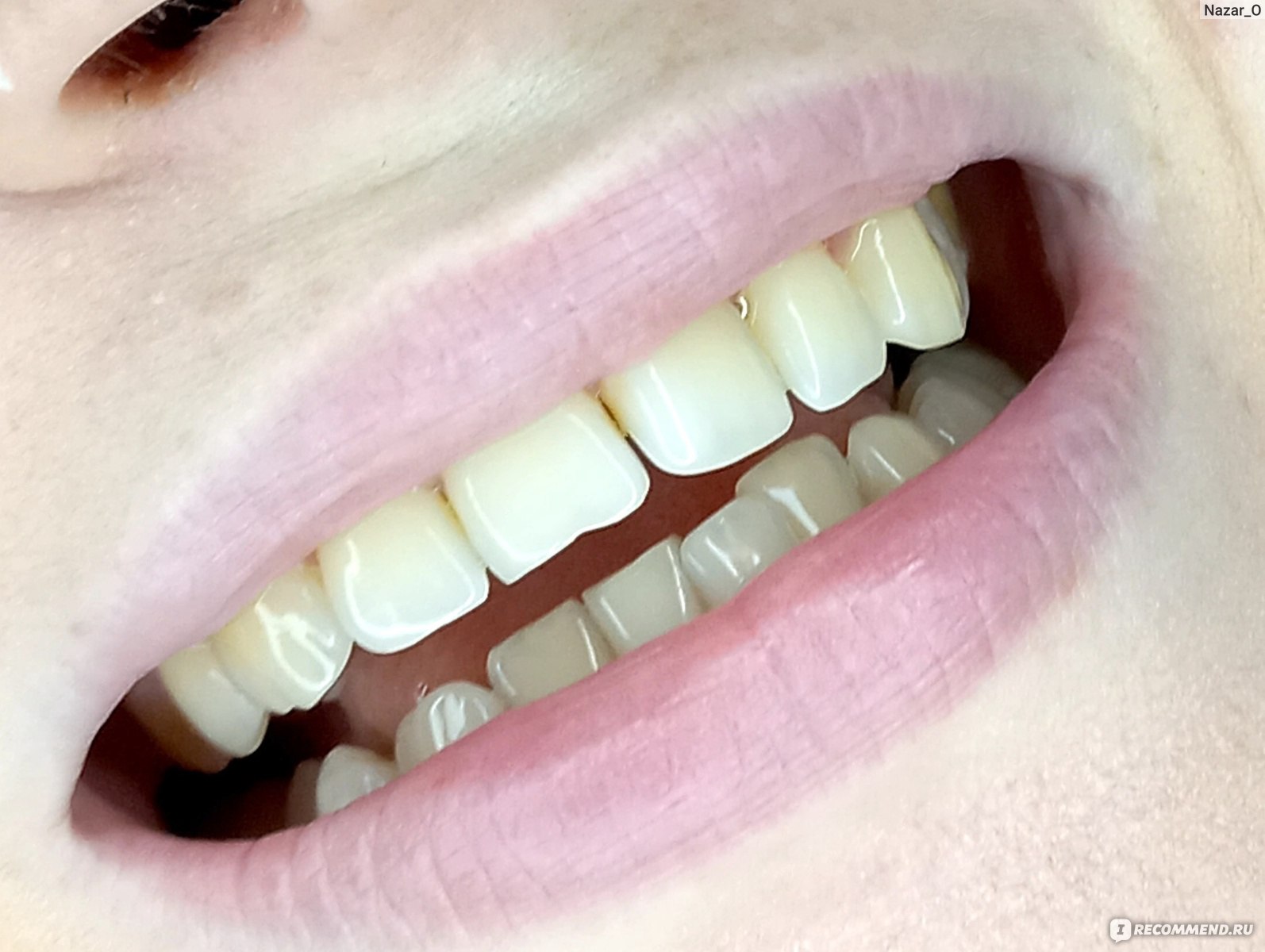 зубной камень передних зубов фото