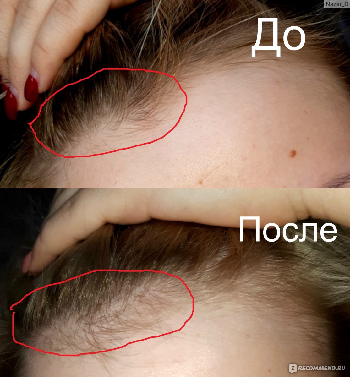 Как избавиться от волос на с помощью мяты