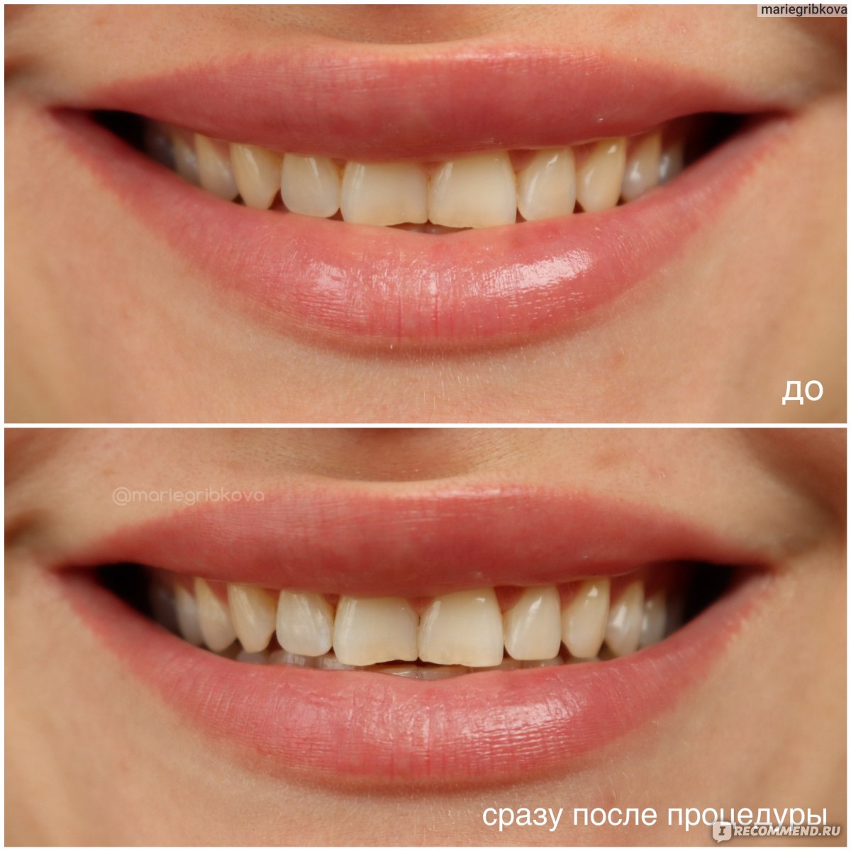 Milkmulatka. Отбеливание зубов до и после. Методики отбеливания зубов.