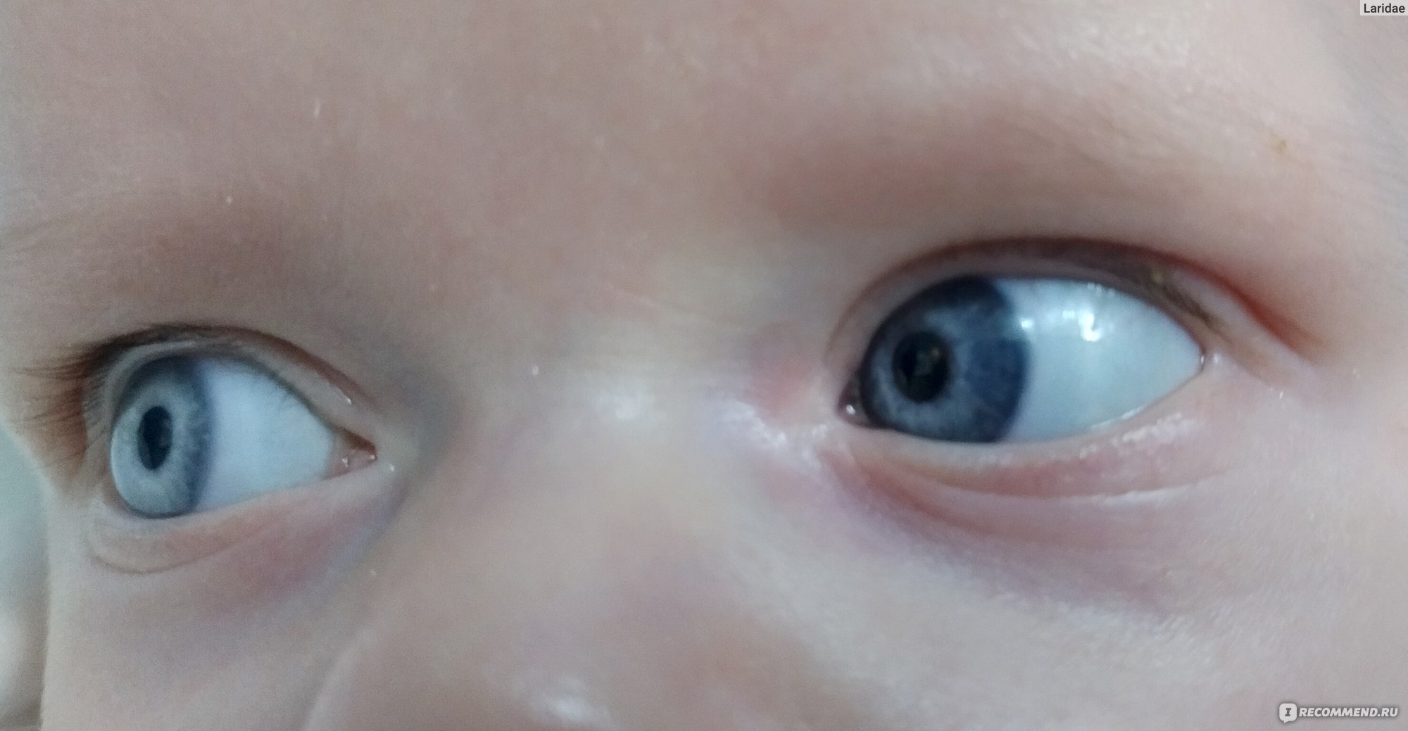 Дакриоцистит капли. Дакриоцистит новорожденных Офтальма. Массаж глаза у новорожденного слезного канала. Дакриоцистит новорожденных тетрациклиновая. Массаж при дакриоцистите новорожденных.