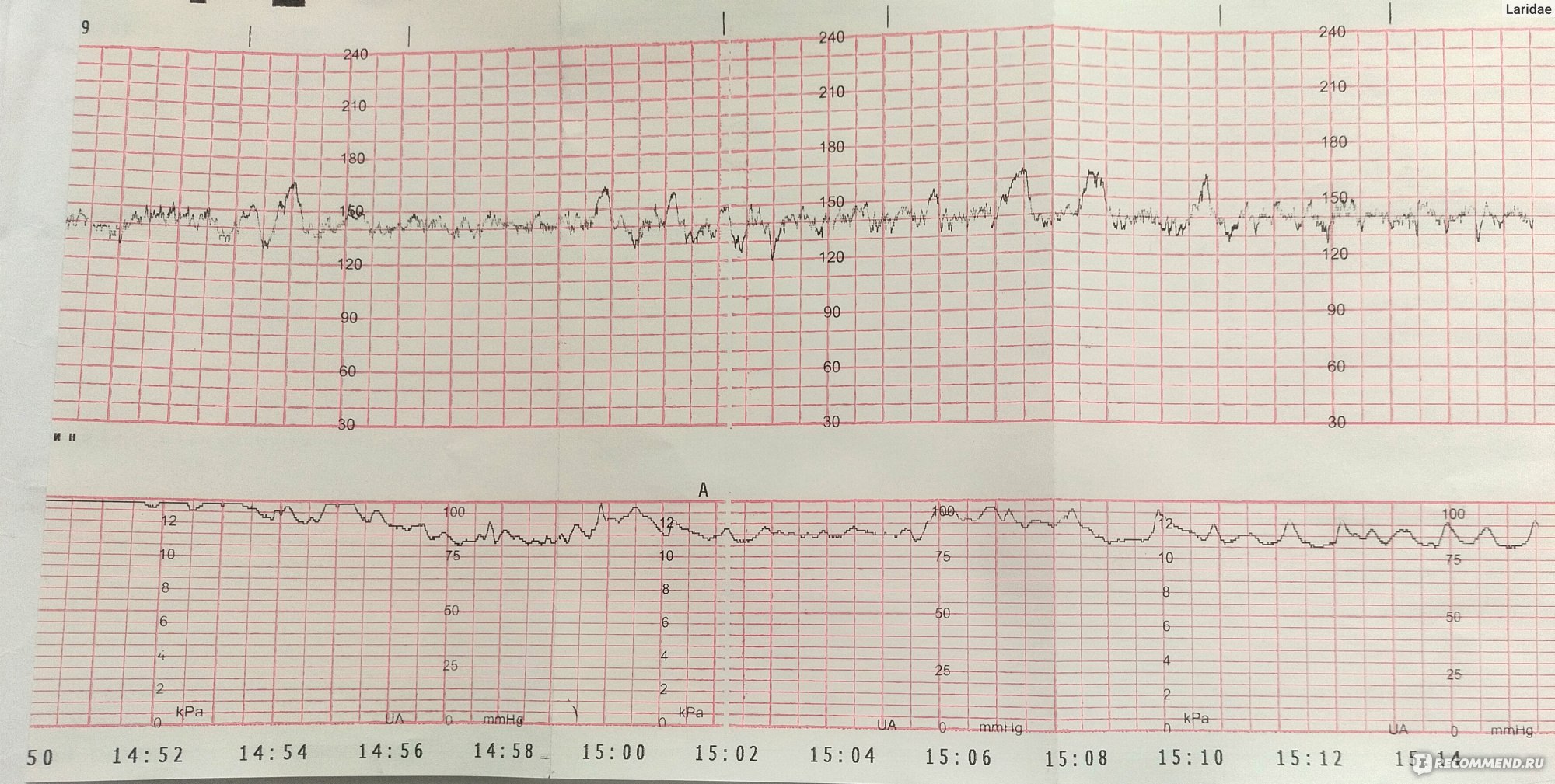 Кардиотокография (КТГ) - «КГТ во время беременности: испытала на себе все  варианты проведения КТГ.» | отзывы
