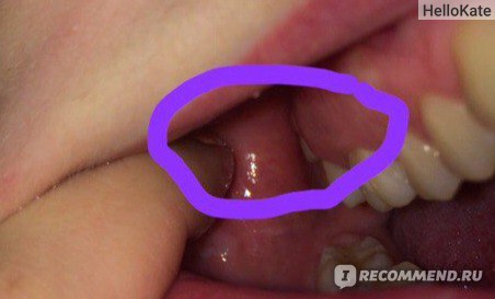 Как привыкнуть к своим съемным протезам Что делать если зубные протезы давят и натирают десну