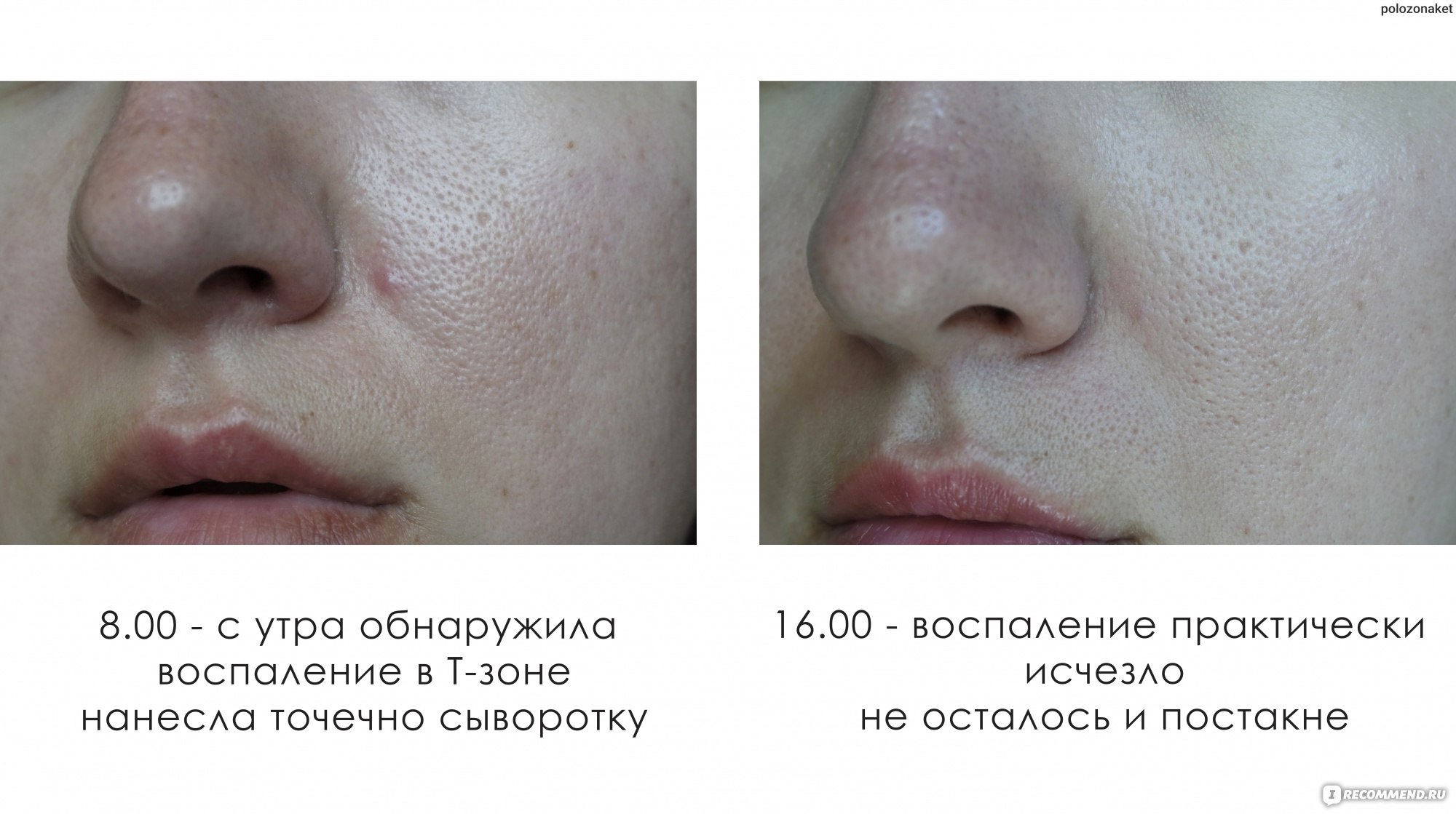 Сыворотка для лица LEFAMI Acne Remover Serum для удаления акне - «Работает!  Действительно экстренная помощь в борьбе с акне, а также борьба с  подкожными воспалениями. Мой результат. » | отзывы