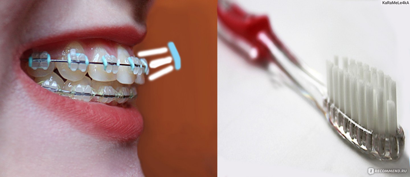 брекеты и электрическая зубная щетка отзывы