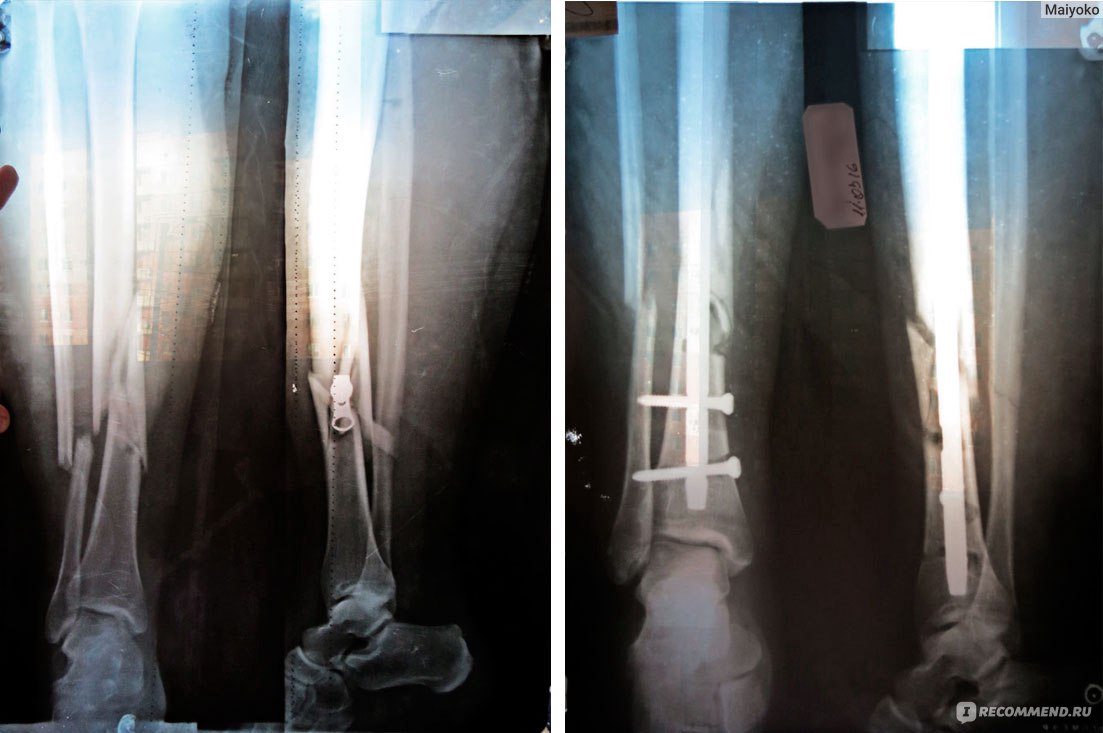 Реабилитация после перелома малой берцовой кости | Медицинский центр 