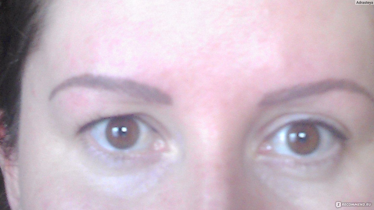 Ptosis of the upper eyelid after Dysport - what should be done?