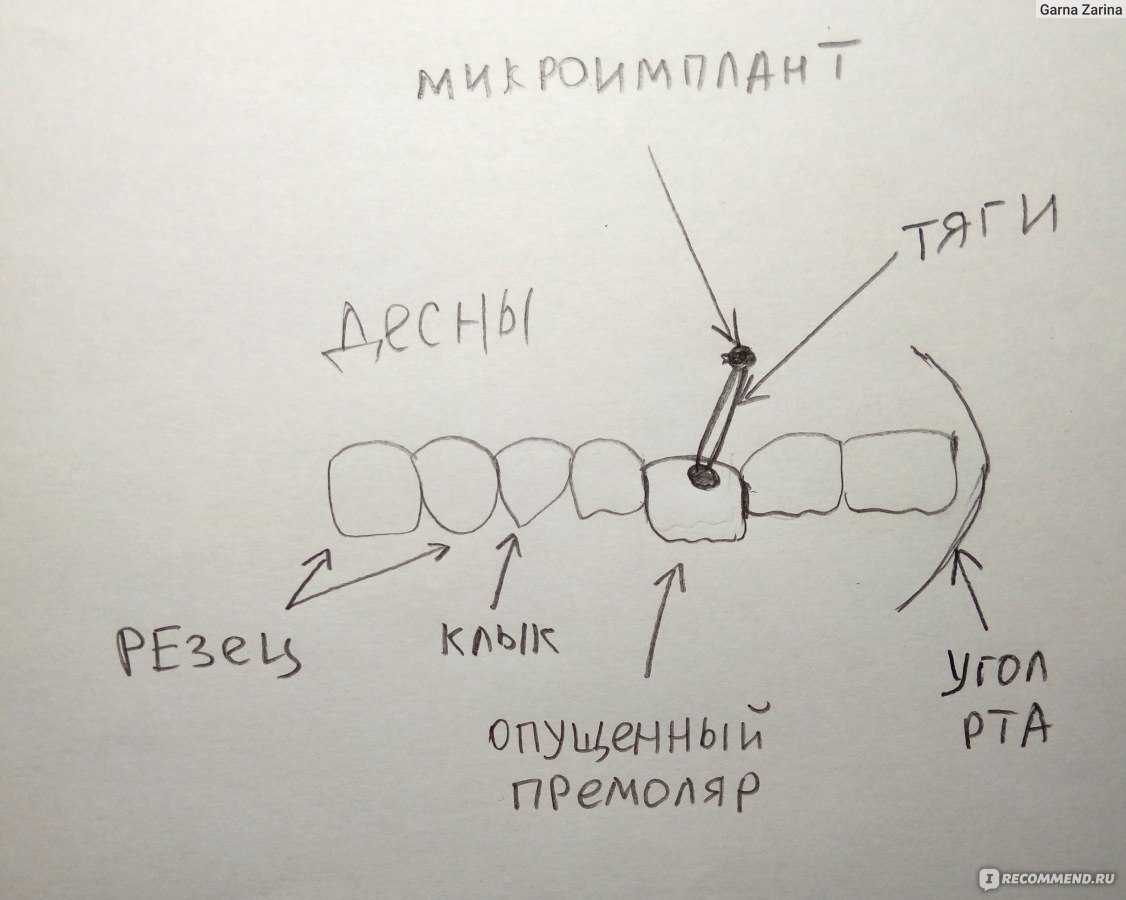 Схема ношения эластиков ортодонтия