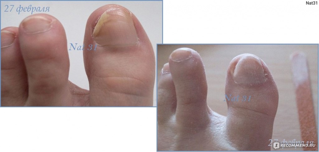 Средство от грибка ногтей на ногах – самые эффективные препараты и народные средства
