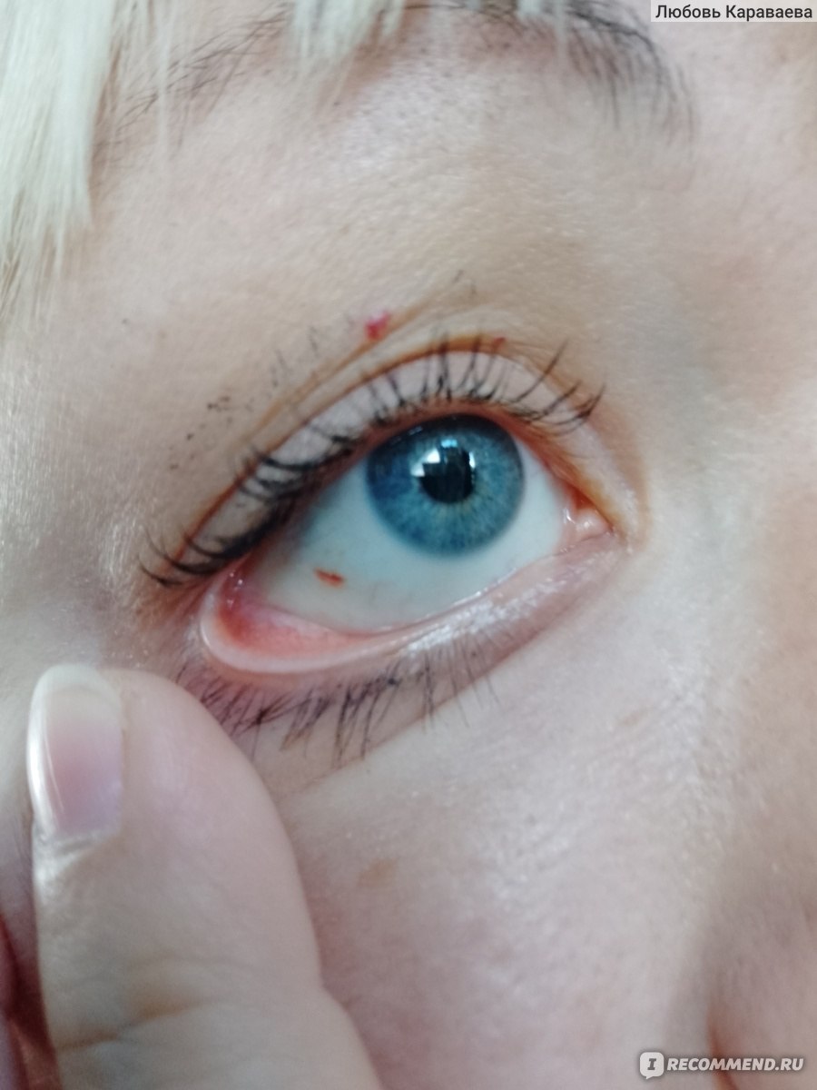 Симптомы кровоизлияний в глаз