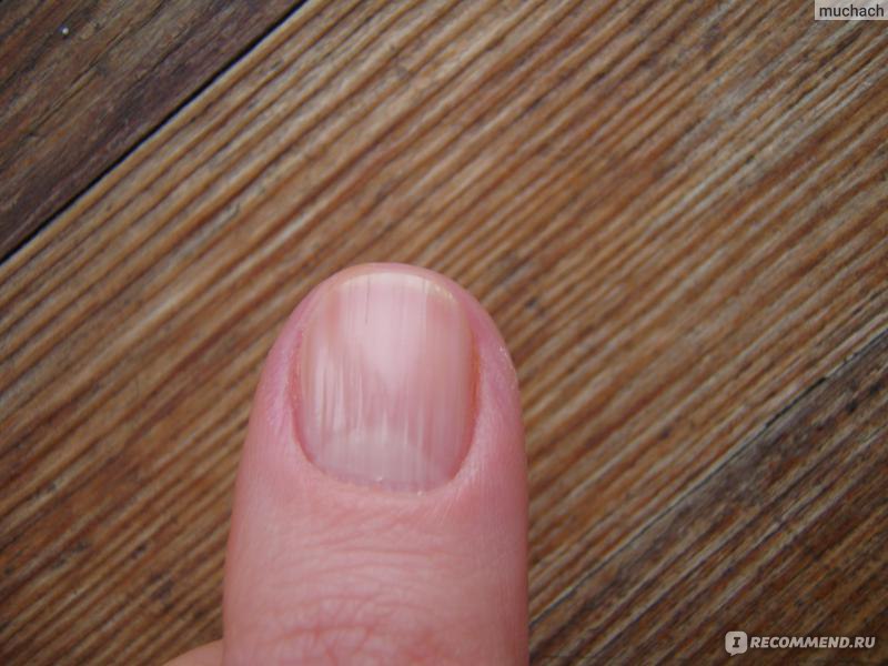 Полоски на ногтях причины вертикальные у женщин. Продольная меланонихия. Продольная грибковая меланонихия. Продольные полоски на ногтях. Продольные борозды на ногтях.