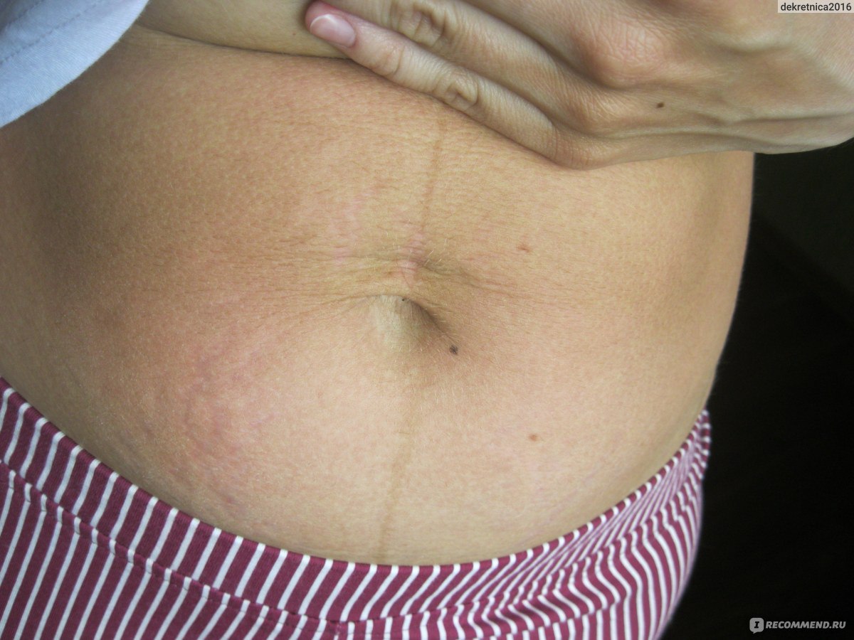 Пигментные пятна при беременности на животе фото