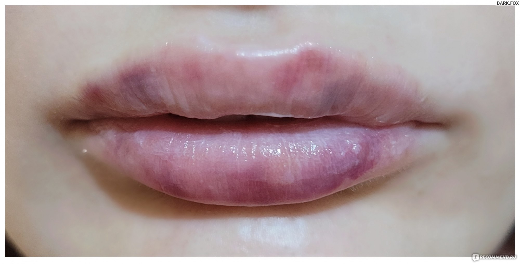 форма губ после гиалуроновой кислоты фото