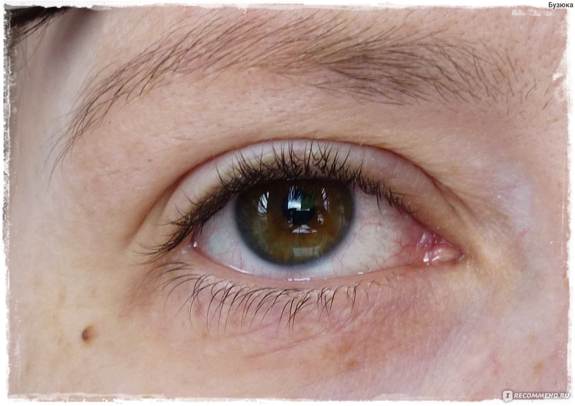 Коньюктивит у ребенка 5. Конъюнктивит глаз у взрослых. В краю глаза конъюнктивит. Конъюнктивит желтые глаза. Первые симптомы конъюнктивита.
