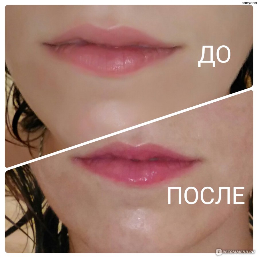 Увеличение губ: как проходит процедура.